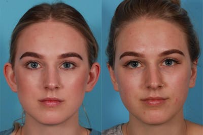 Ear Surgery (Otoplasty) Before & After Gallery - Patient 240366 - Image 1