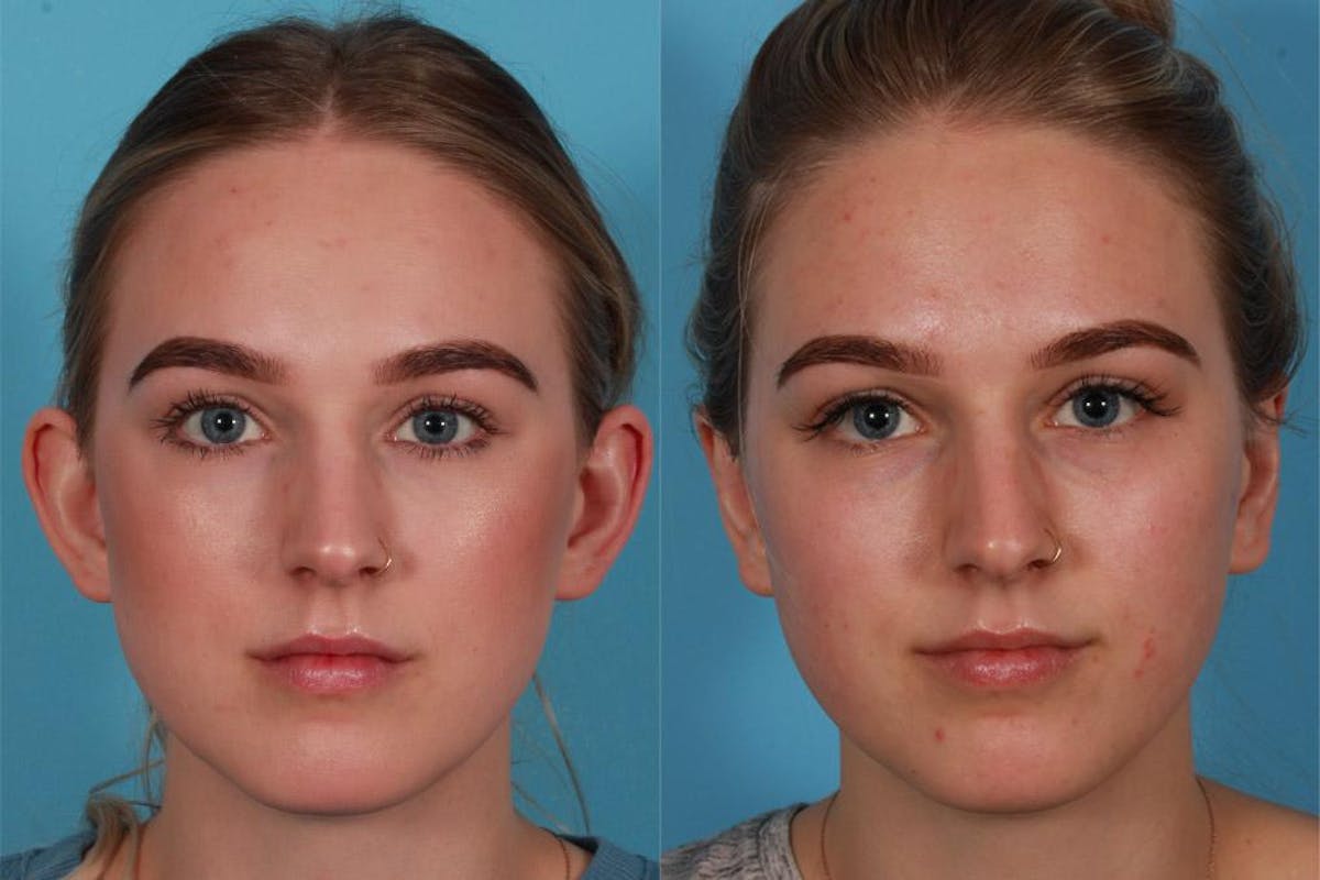 Ear Surgery (Otoplasty) Before & After Gallery - Patient 240366 - Image 1