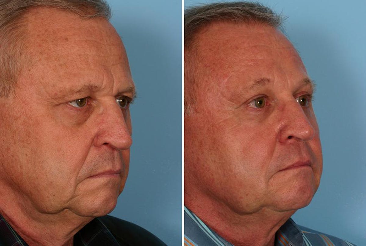 Endoscoplic Browlift Before & After Gallery - Patient 270433 - Image 6