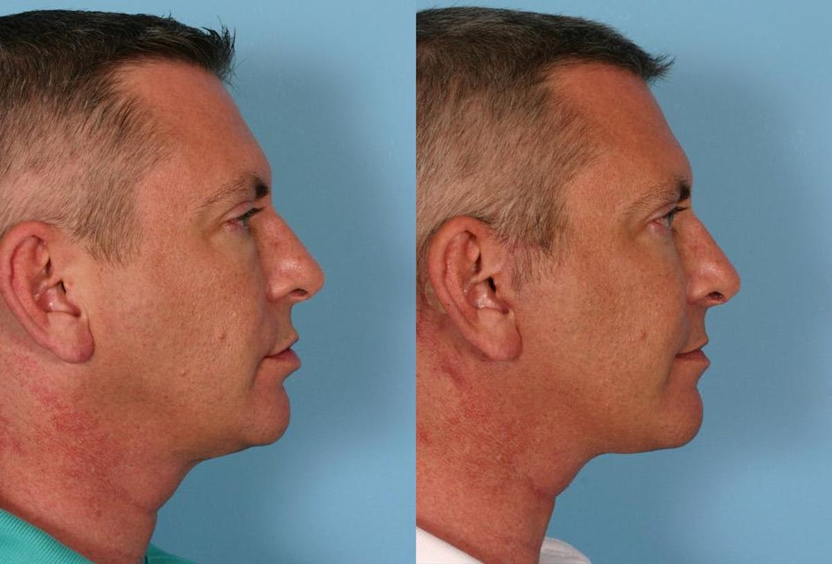 Limited Incision Facelift Before & After Gallery - Patient 302619 - Image 3