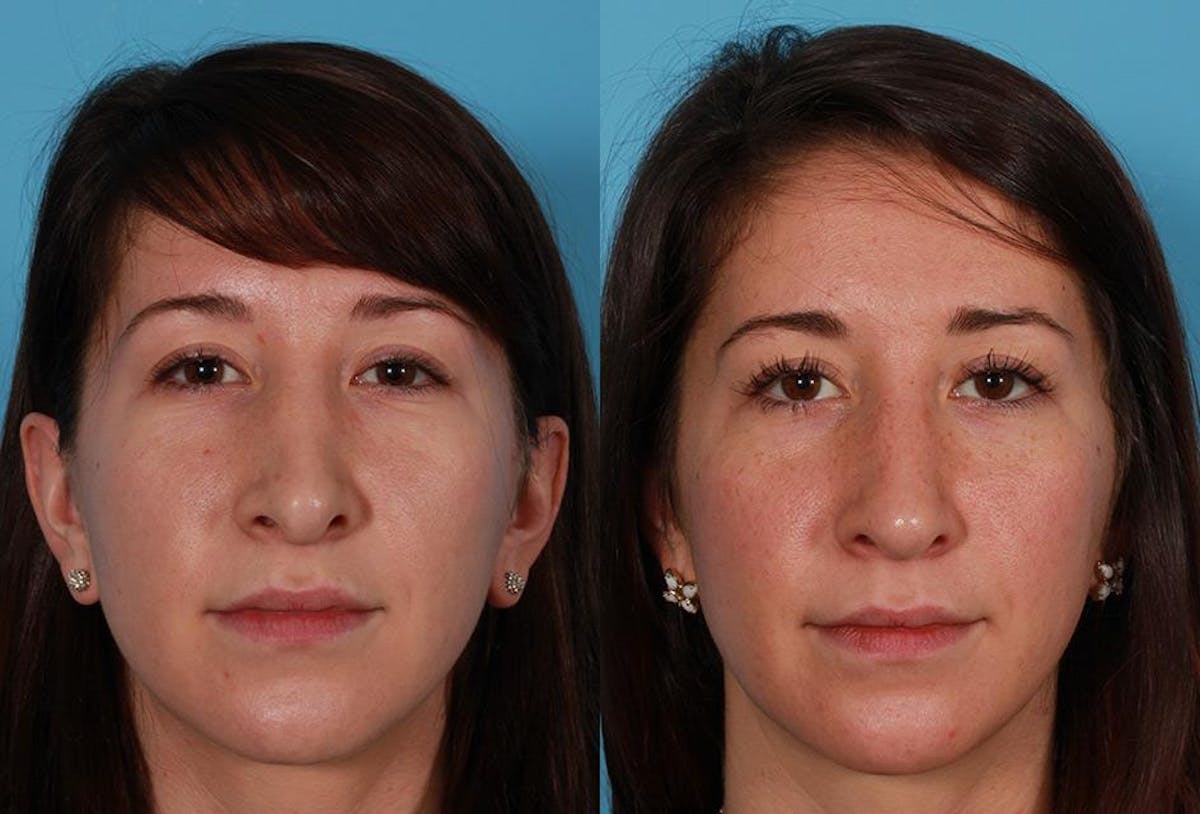 Revision Rhinoplasty Before & After Gallery - Patient 466512 - Image 1