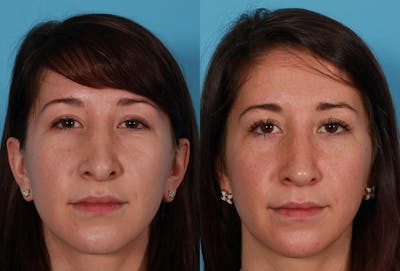 Revision Rhinoplasty Before & After Gallery - Patient 466512 - Image 1