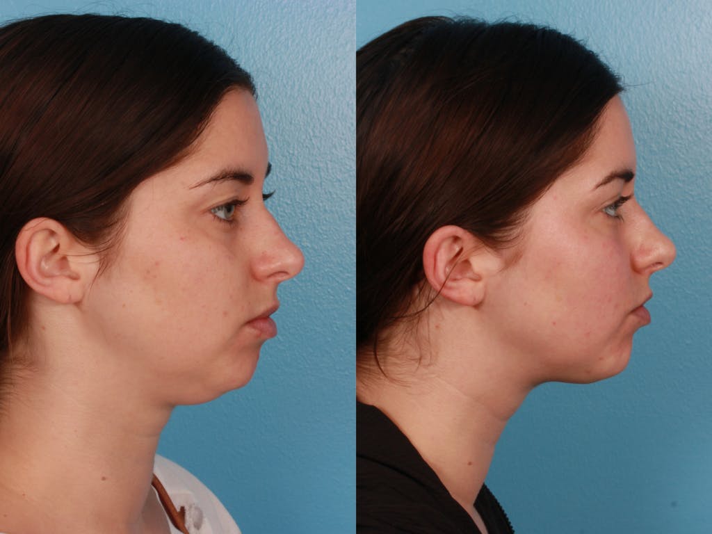 Submental Microliposuction Before & After Gallery - Patient 375684 - Image 3