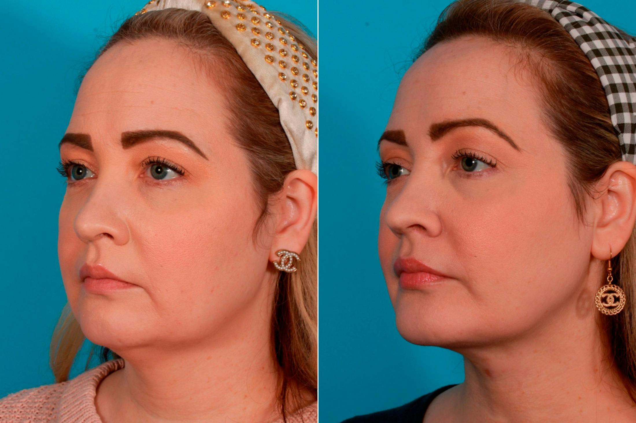 Neck Lift Before & After Gallery - Patient 387292 - Image 3