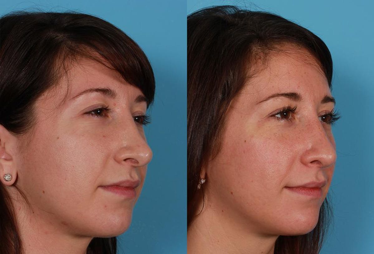 Revision Rhinoplasty Before & After Gallery - Patient 466512 - Image 2