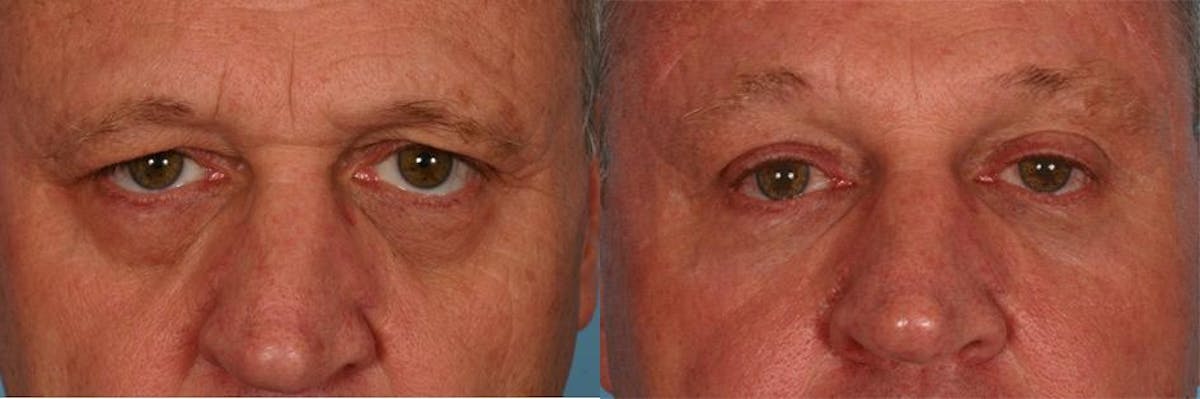 Eyelid Surgery (Blepharoplasty) Before & After Gallery - Patient 237902 - Image 1