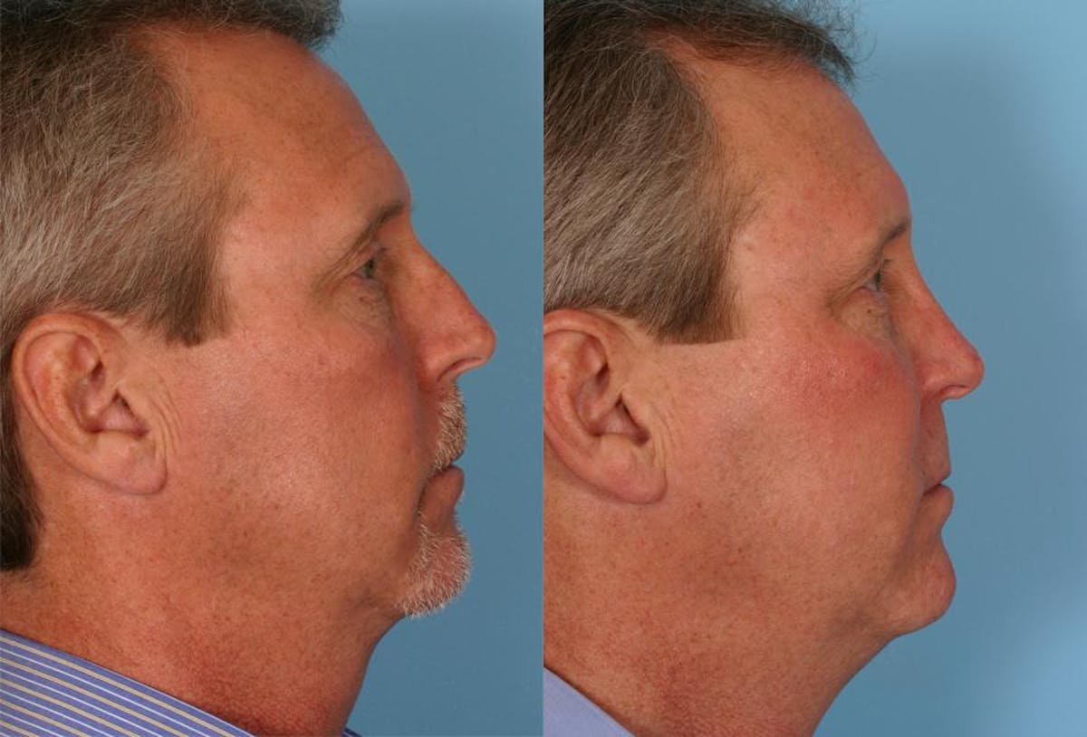 Nasal Obstruction Before & After Gallery - Patient 197788 - Image 2
