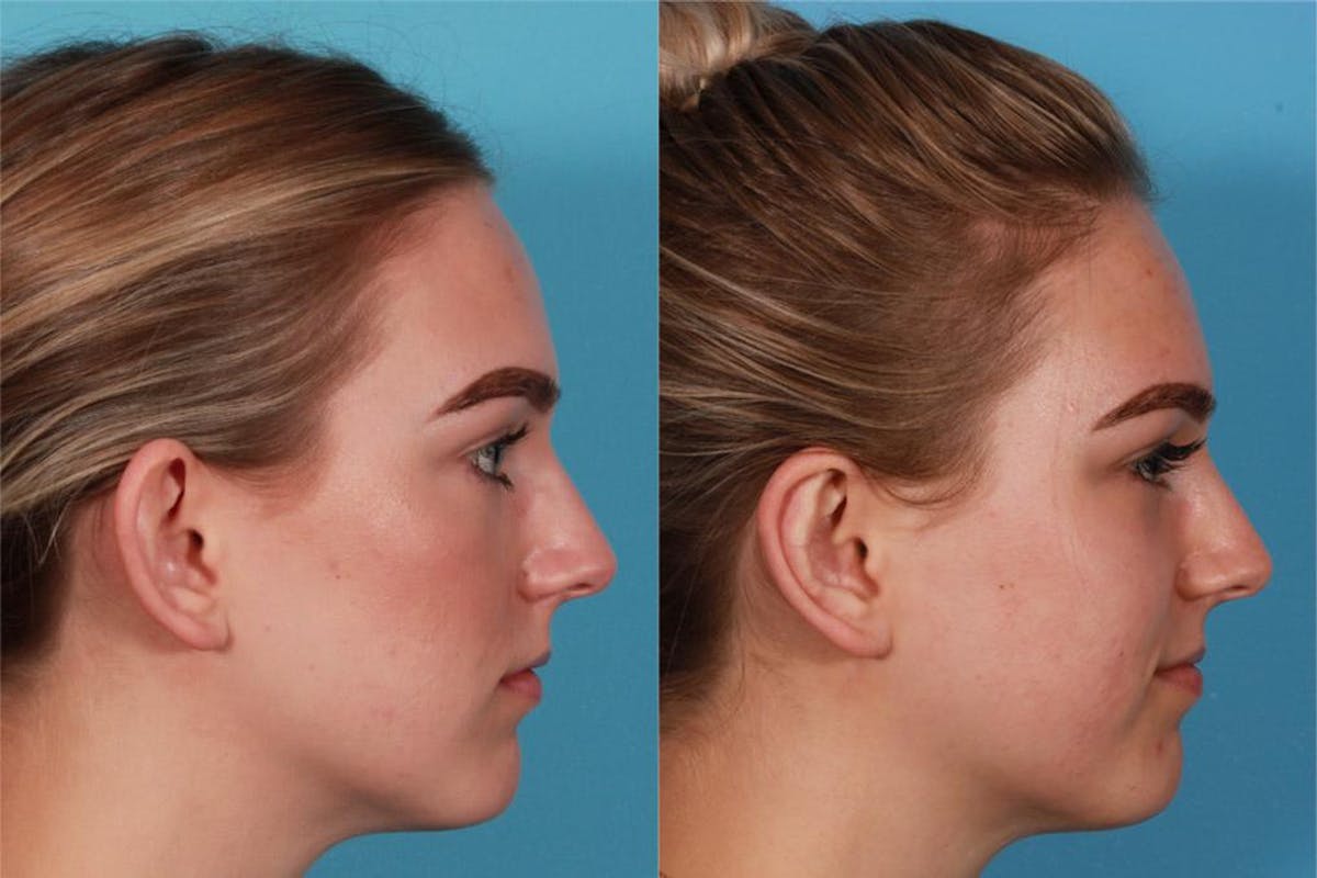 Ear Surgery (Otoplasty) Before & After Gallery - Patient 240366 - Image 3
