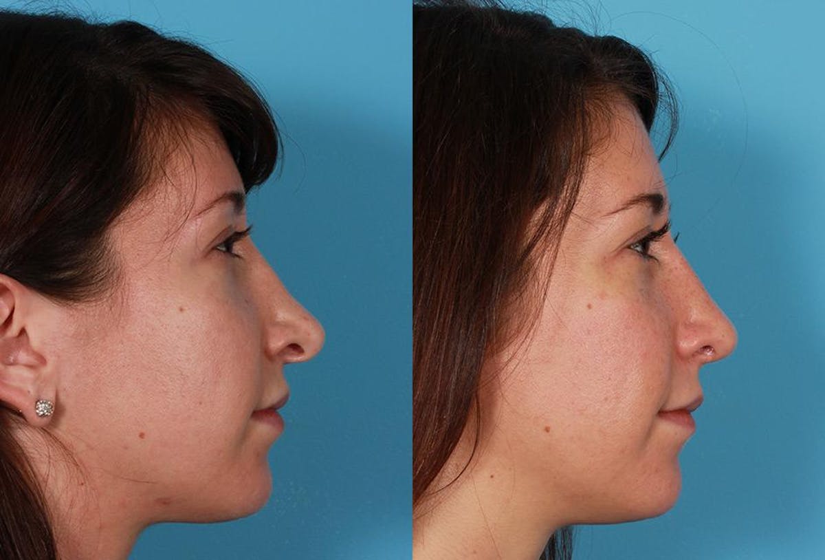 Revision Rhinoplasty Before & After Gallery - Patient 466512 - Image 3