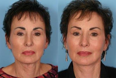Facelift Before & After Gallery - Patient 384726 - Image 1