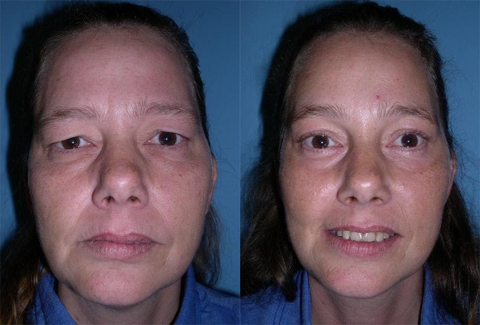 Endoscopic Brow Lift Before & After Gallery - Patient 187845 - Image 1