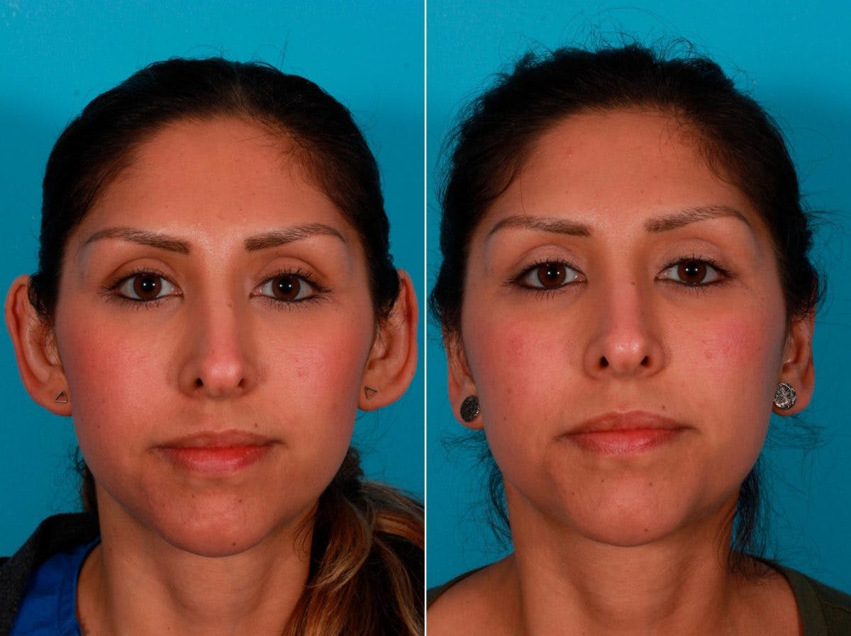 Ear Surgery (Otoplasty) Before & After Gallery - Patient 232046 - Image 1