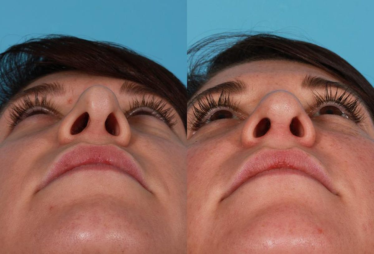 Revision Rhinoplasty Before & After Gallery - Patient 466512 - Image 4