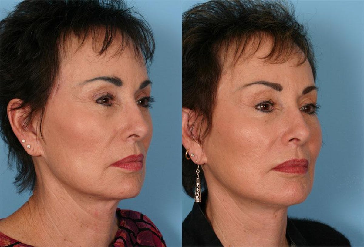 Facelift Before & After Gallery - Patient 384726 - Image 2