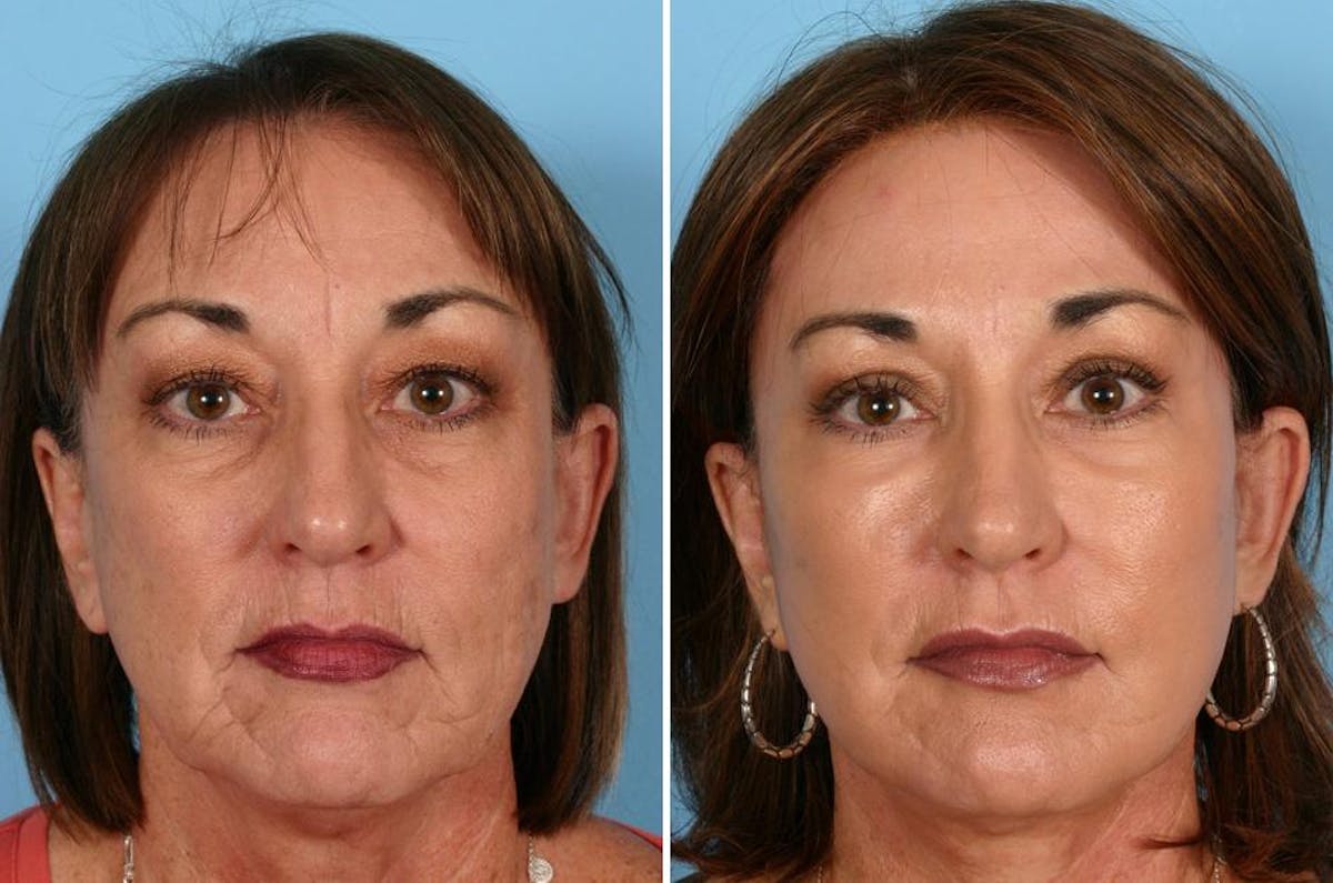 TCA Peel / Dermabrasion Before & After Gallery - Patient 150134 - Image 5