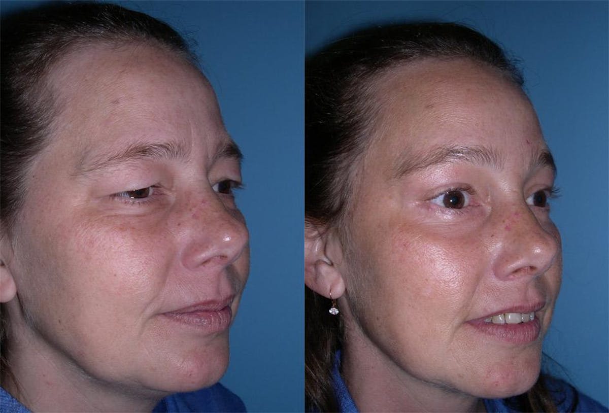 Endoscoplic Browlift Before & After Gallery - Patient 187845 - Image 2