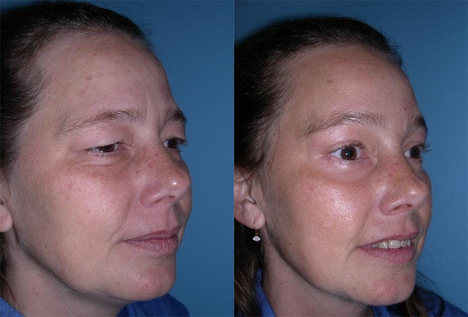 Endoscopic Brow Lift Before & After Gallery - Patient 187845 - Image 2
