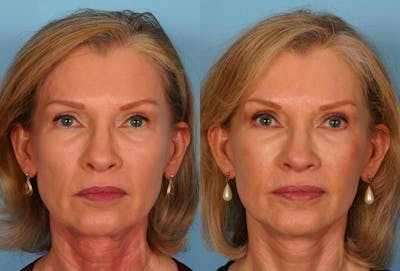 Limited Incision Facelift Before & After Gallery - Patient 276560 - Image 1