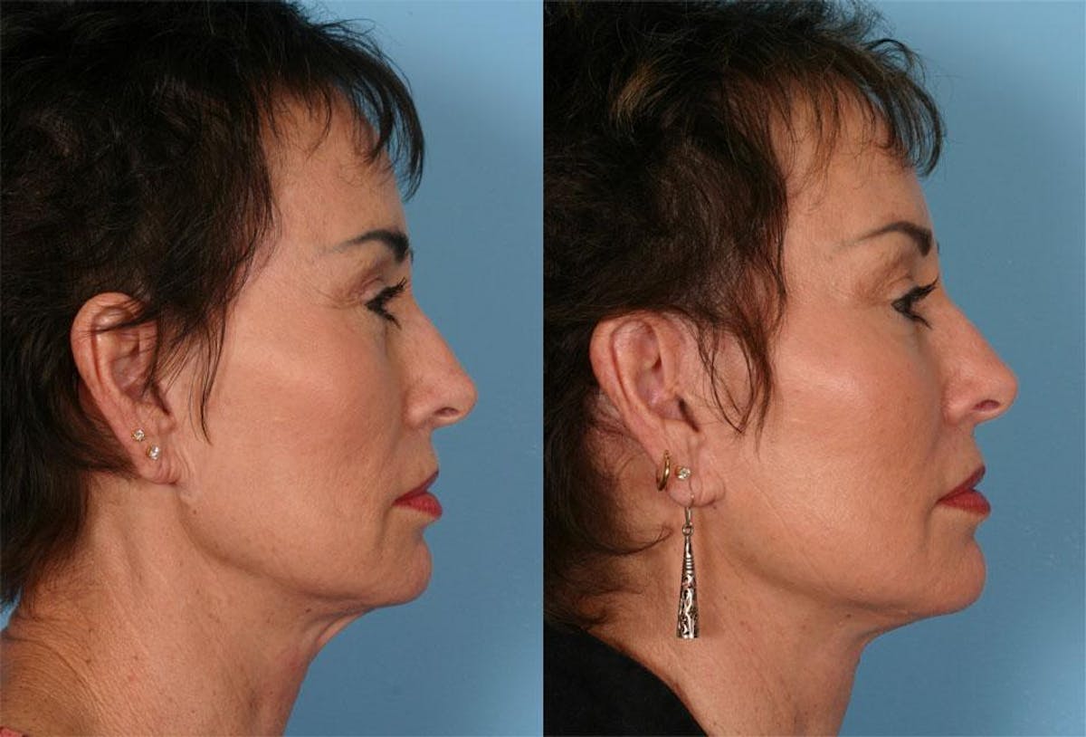 Facelift Before & After Gallery - Patient 384726 - Image 3