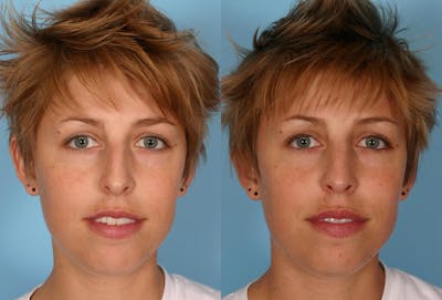Nasal Obstruction Before & After Gallery - Patient 962609 - Image 1