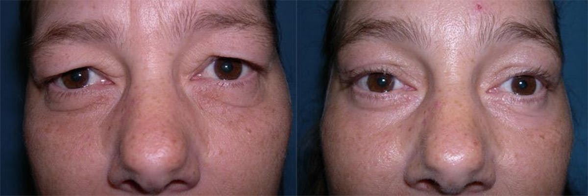 Endoscoplic Browlift Before & After Gallery - Patient 187845 - Image 3