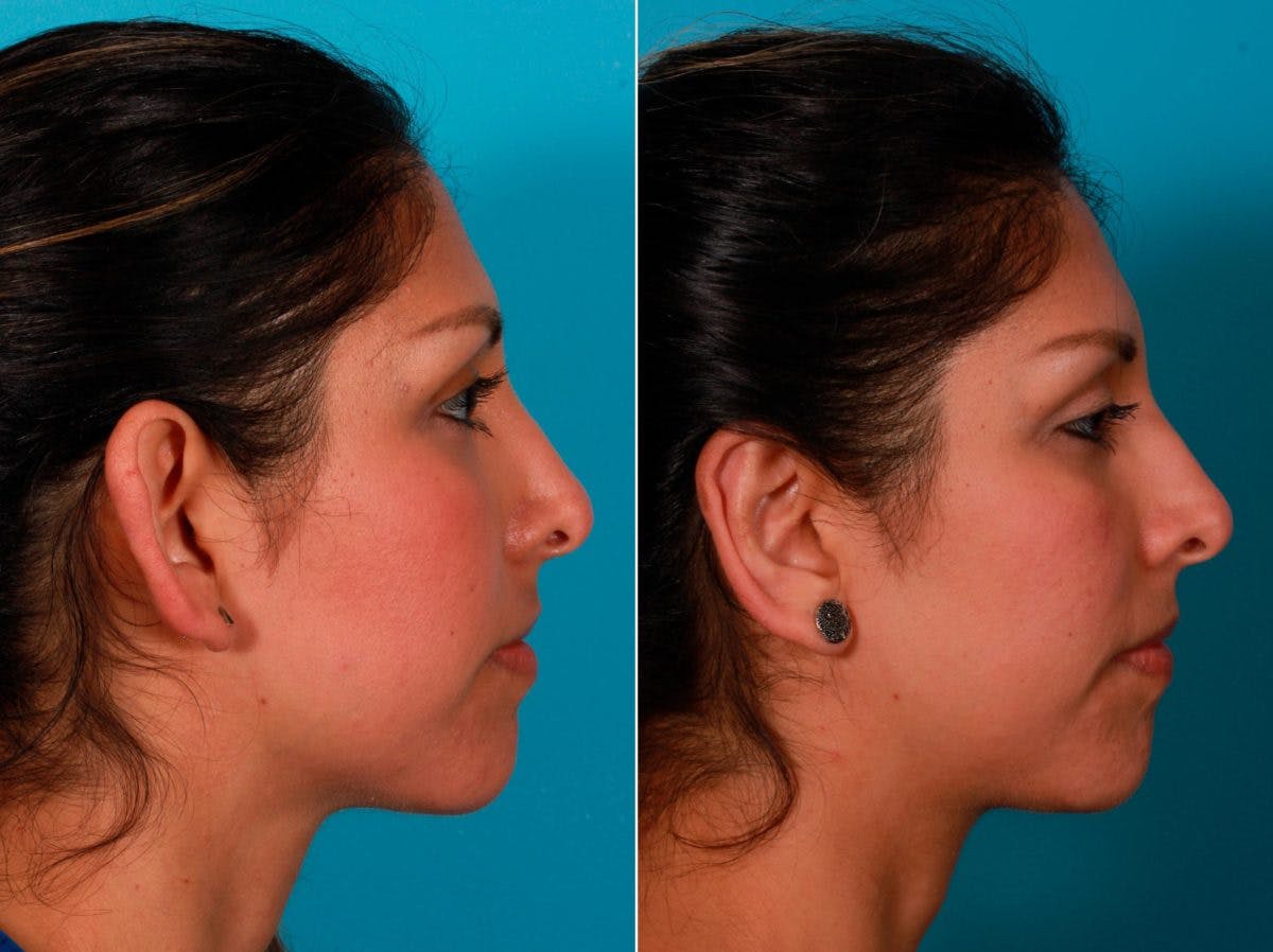 Ear Surgery (Otoplasty) Before & After Gallery - Patient 232046 - Image 3