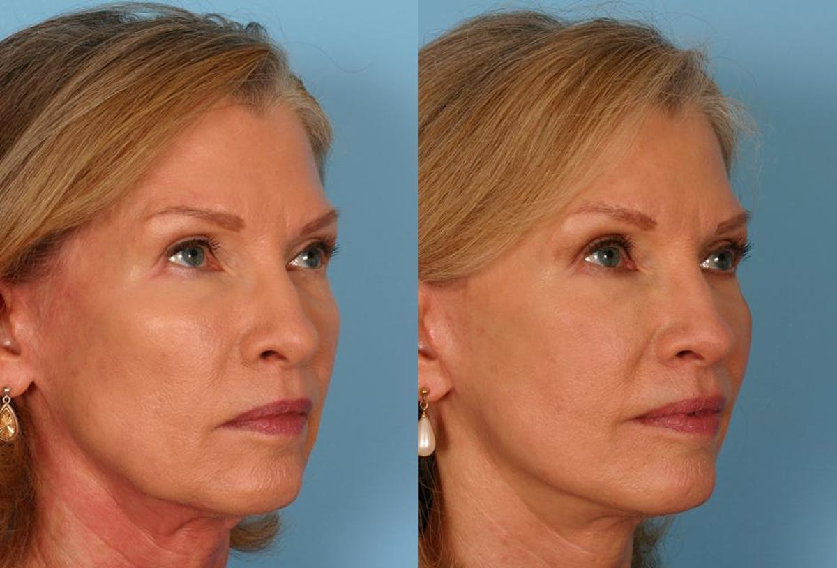 Limited Incision Facelift Before & After Gallery - Patient 276560 - Image 2