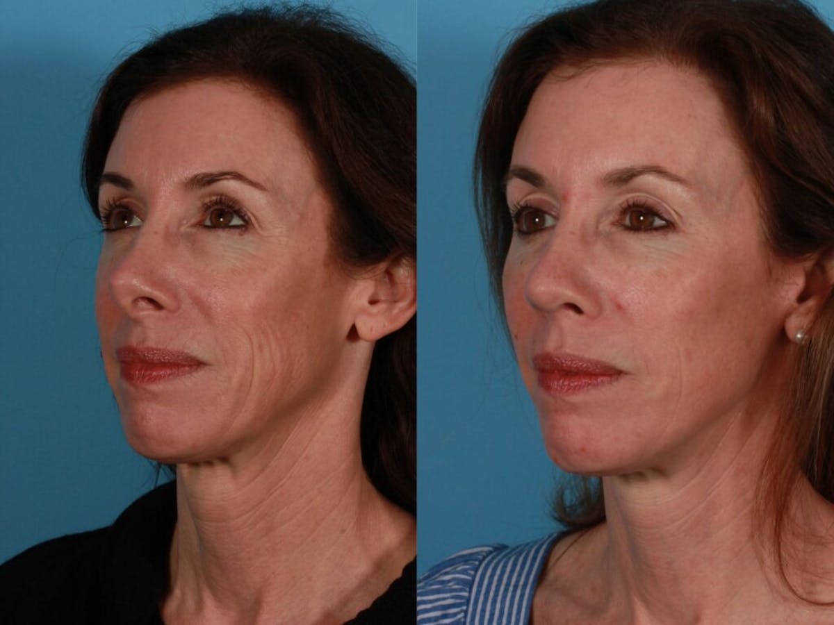 Revision Rhinoplasty Before & After Gallery - Patient 185441 - Image 2