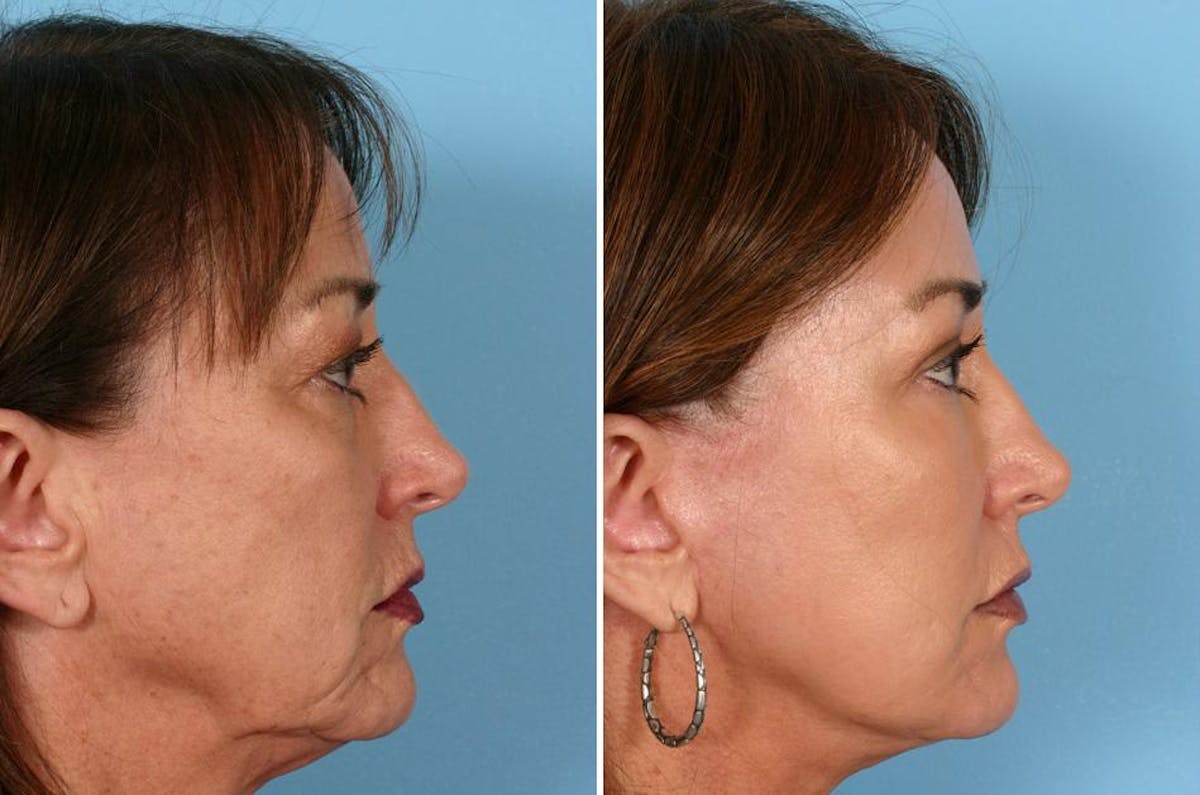 TCA Peel / Dermabrasion Before & After Gallery - Patient 150134 - Image 7