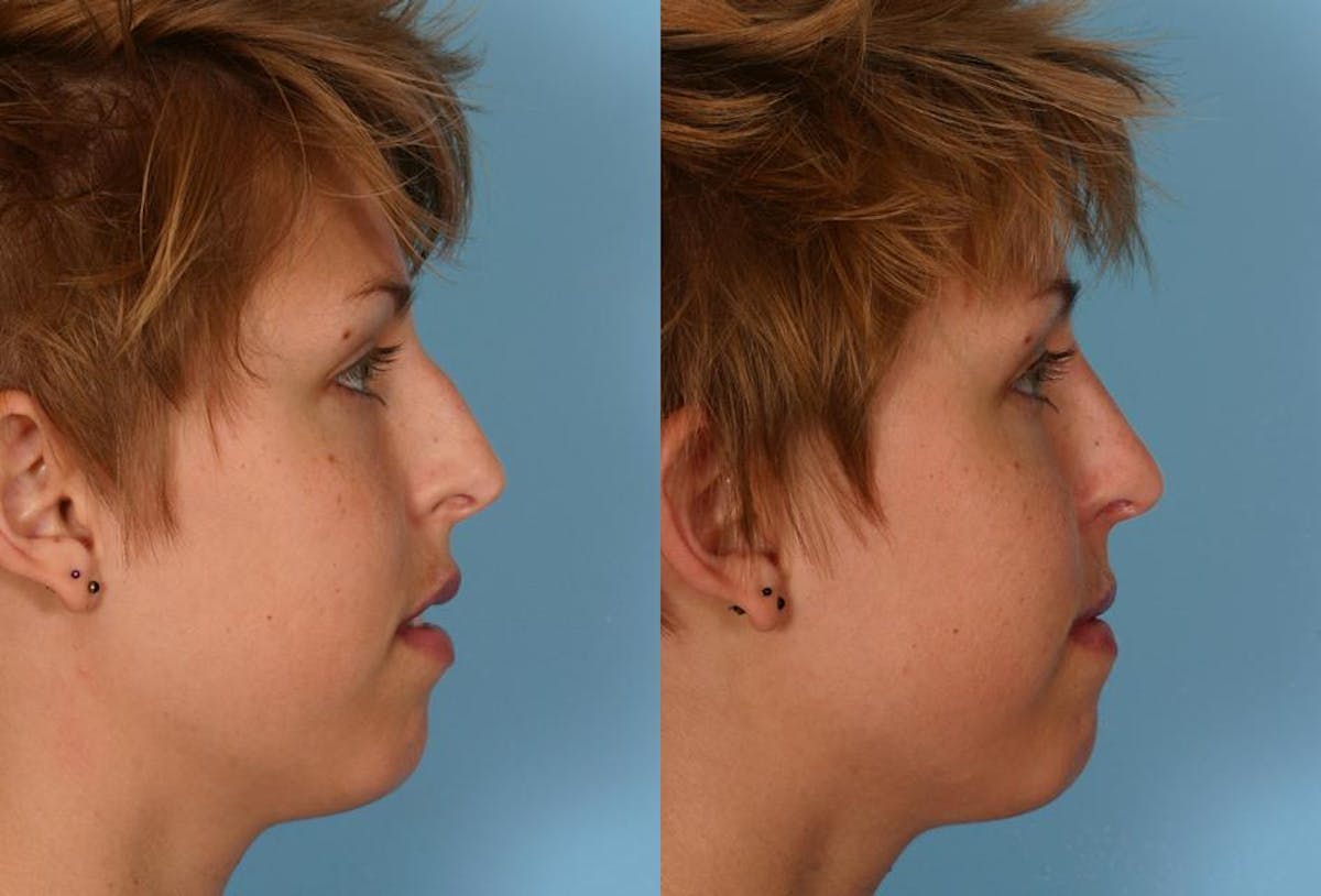 Nasal Obstruction Before & After Gallery - Patient 962609 - Image 2