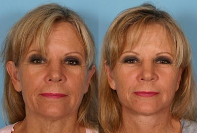 Facelift Before & After Gallery - Patient 233681 - Image 1