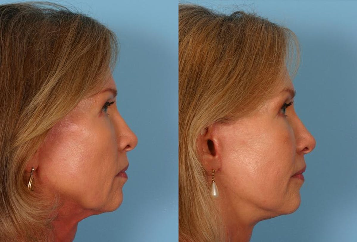 Limited Incision Facelift Before & After Gallery - Patient 276560 - Image 3