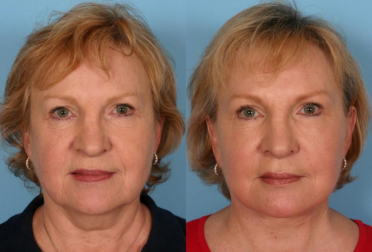 Endoscoplic Browlift Before & After Gallery - Patient 238612 - Image 1