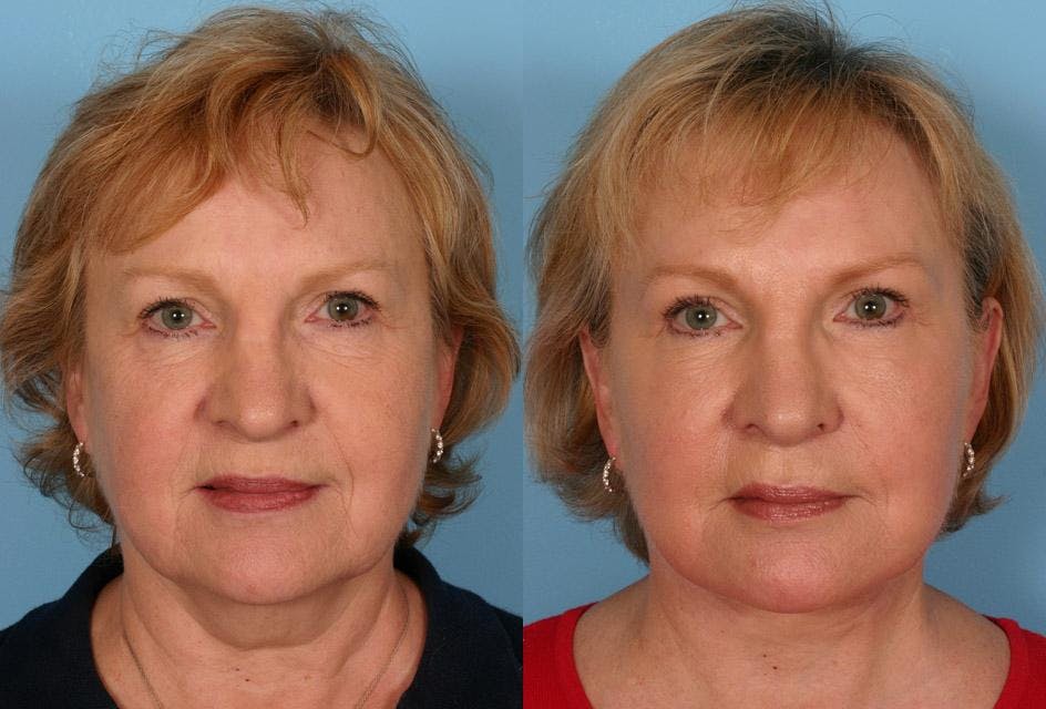 Endoscopic Brow Lift Before & After Gallery - Patient 238612 - Image 1