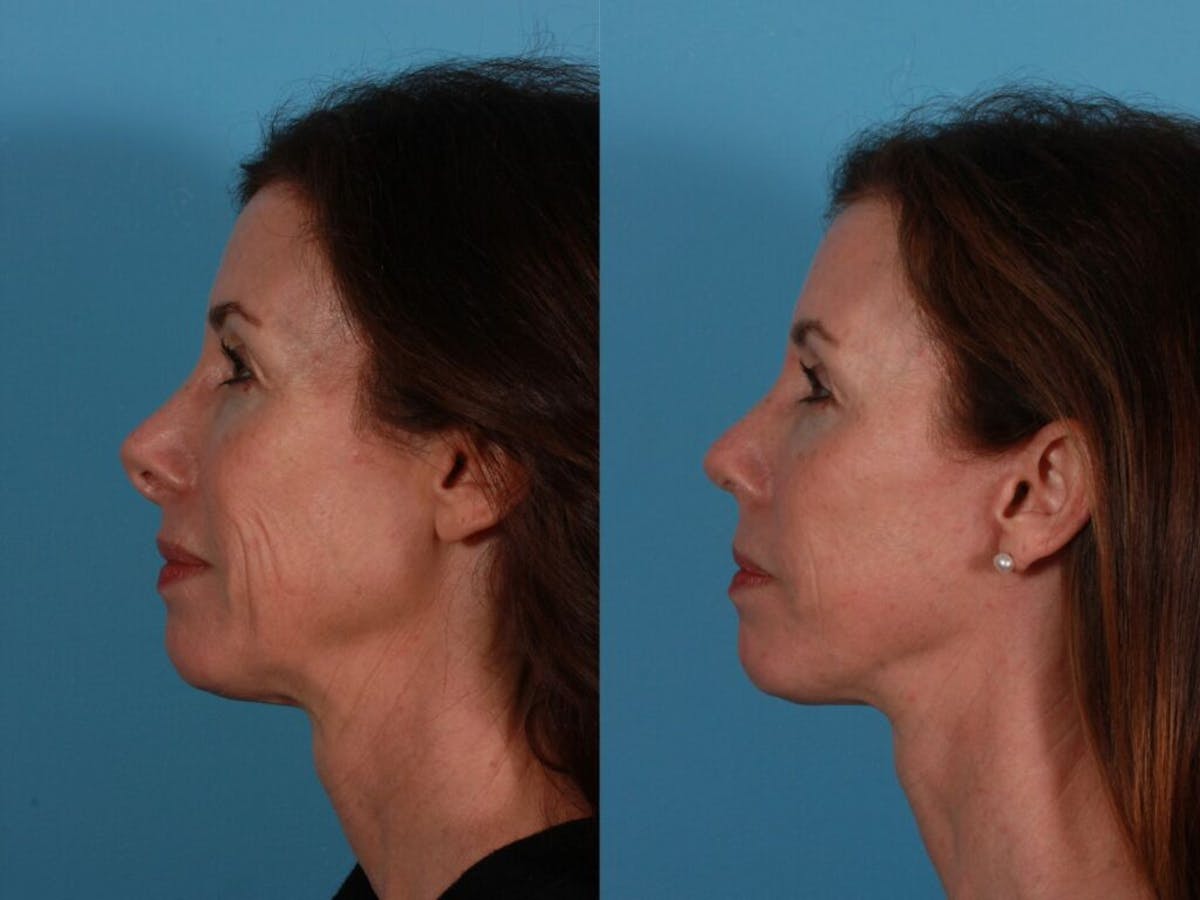 Revision Rhinoplasty Before & After Gallery - Patient 185441 - Image 3