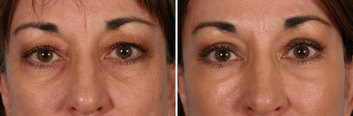 TCA Peel / Dermabrasion Before & After Gallery - Patient 150134 - Image 8