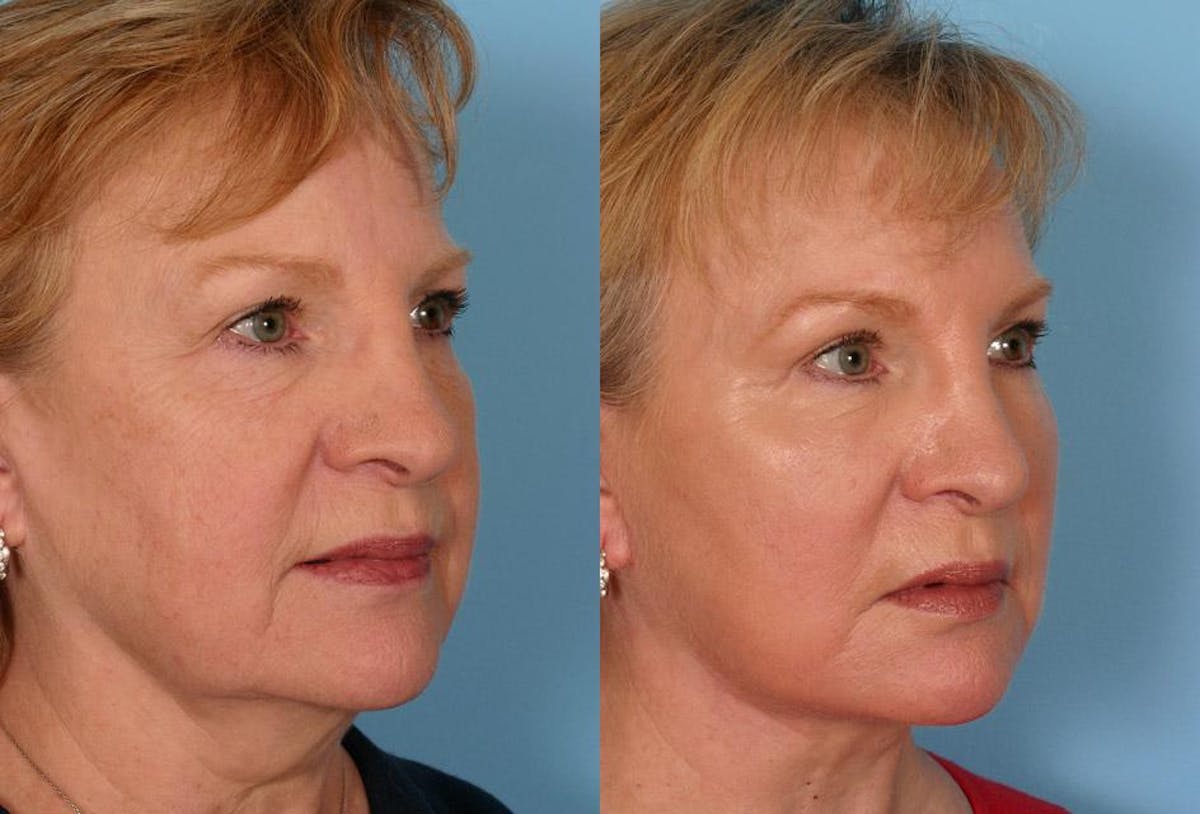 Endoscoplic Browlift Before & After Gallery - Patient 238612 - Image 2