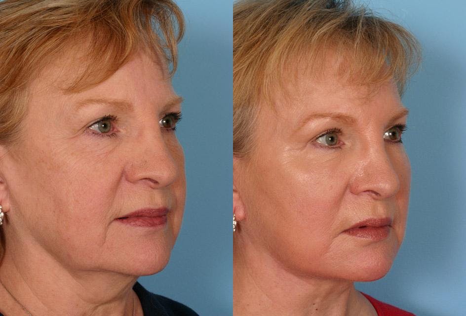 Endoscopic Brow Lift Before & After Gallery - Patient 238612 - Image 2