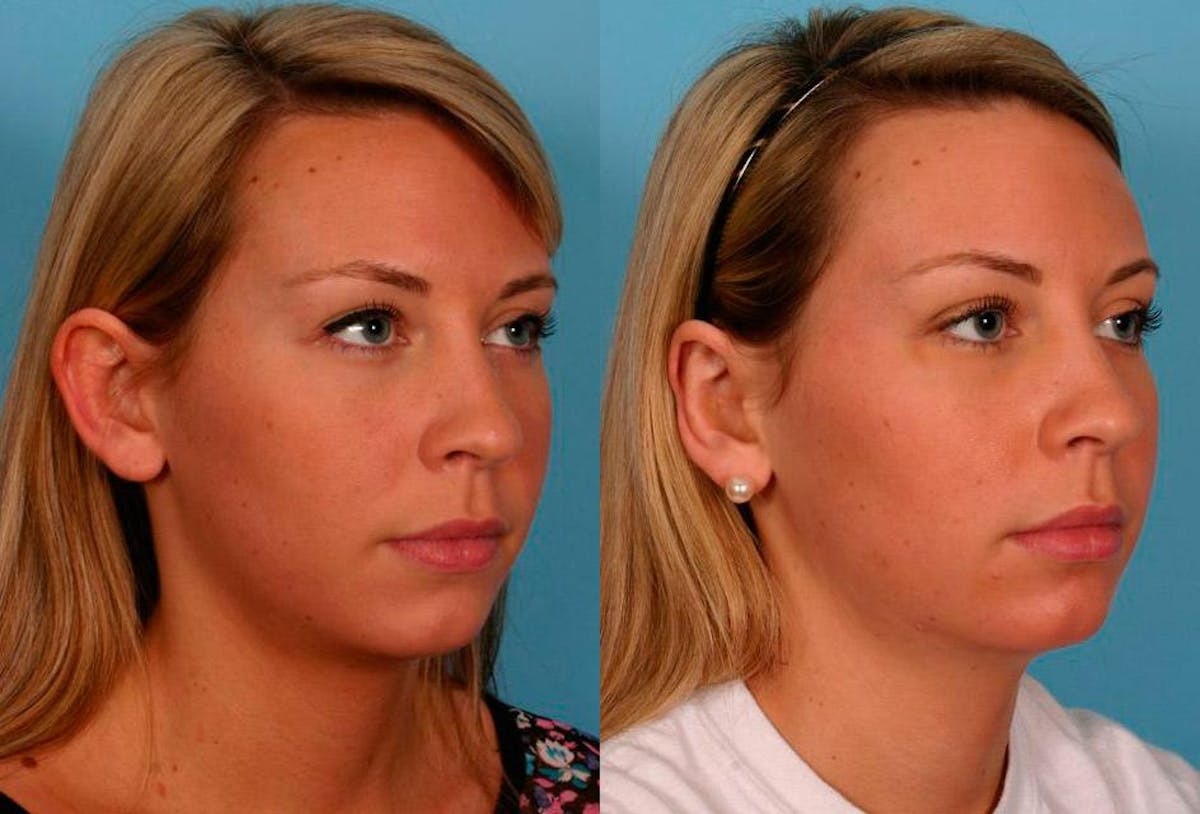 Ear Surgery (Otoplasty) Before & After Gallery - Patient 251414 - Image 2