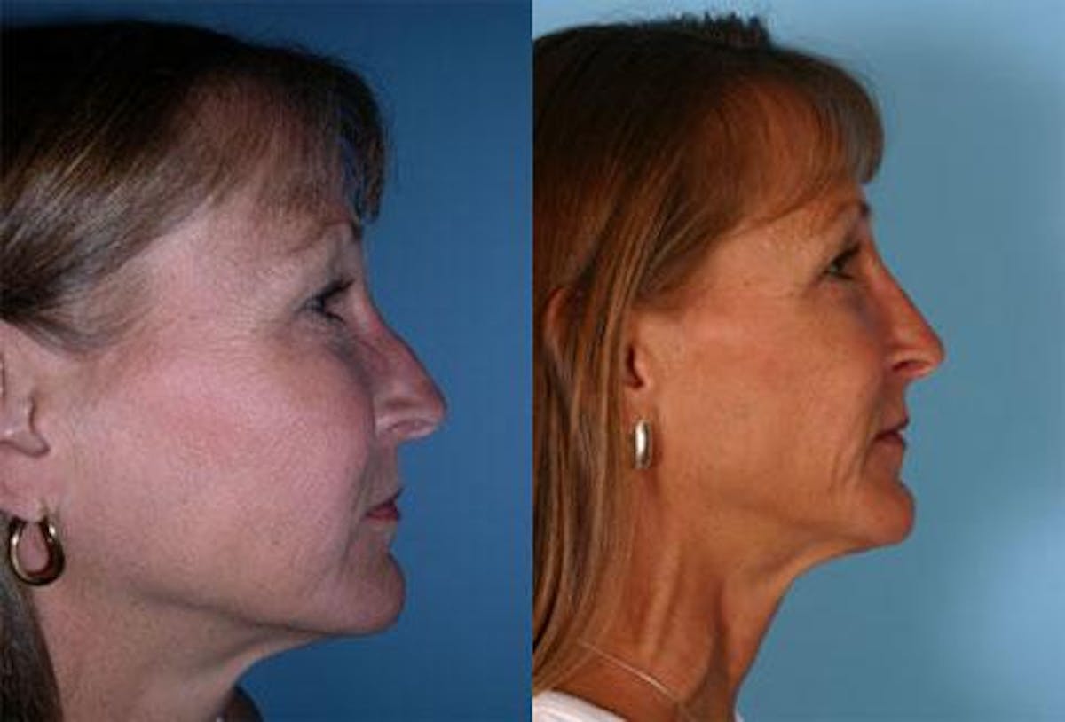 Nasal Obstruction Before & After Gallery - Patient 180024 - Image 2