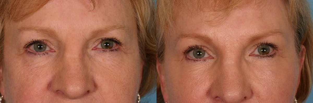 Endoscoplic Browlift Before & After Gallery - Patient 238612 - Image 3