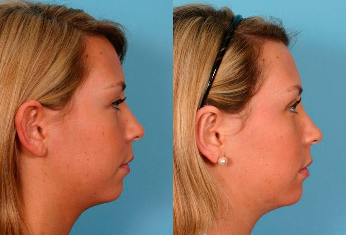 Ear Surgery (Otoplasty) Before & After Gallery - Patient 251414 - Image 3