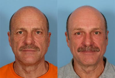 Endoscoplic Browlift Before & After Gallery - Patient 823519 - Image 1