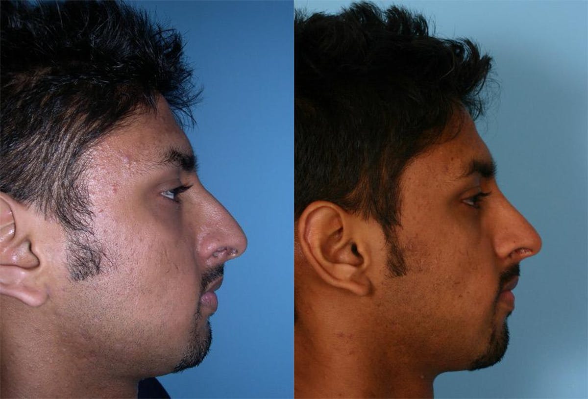 Nasal Obstruction Before & After Gallery - Patient 379882 - Image 2