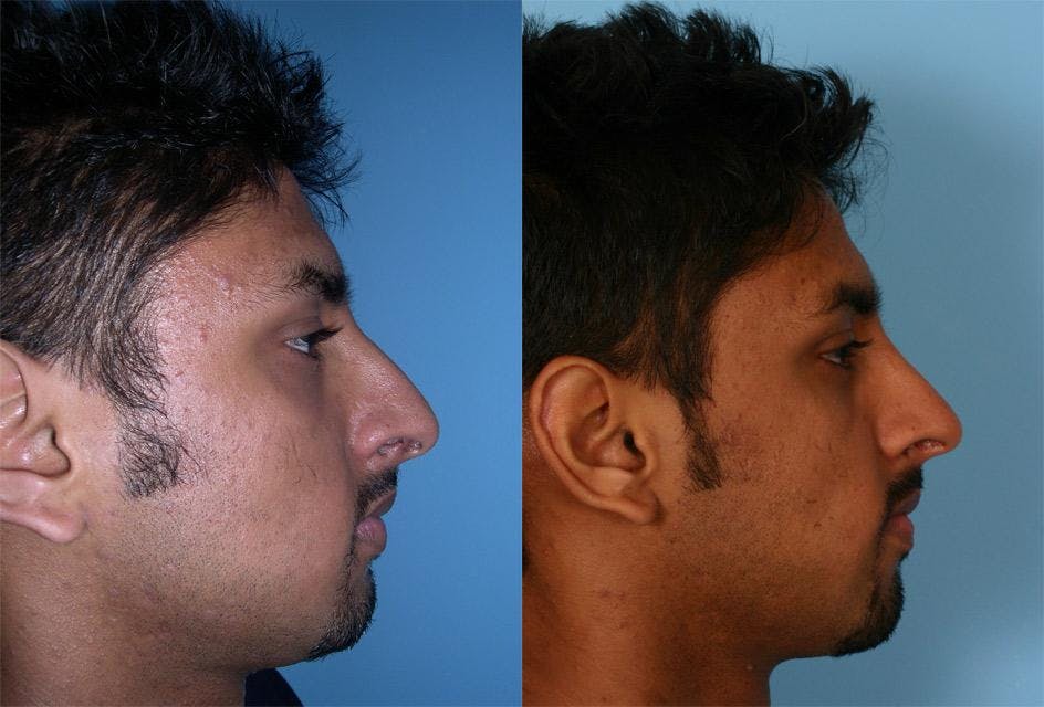 Nasal Obstruction Before & After Gallery - Patient 379882 - Image 2