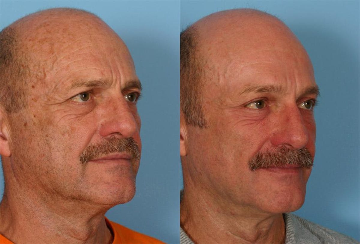 Endoscoplic Browlift Before & After Gallery - Patient 823519 - Image 2