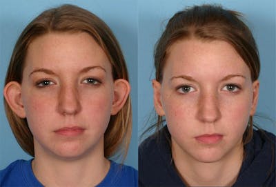 Ear Surgery (Otoplasty) Before & After Gallery - Patient 260357 - Image 1