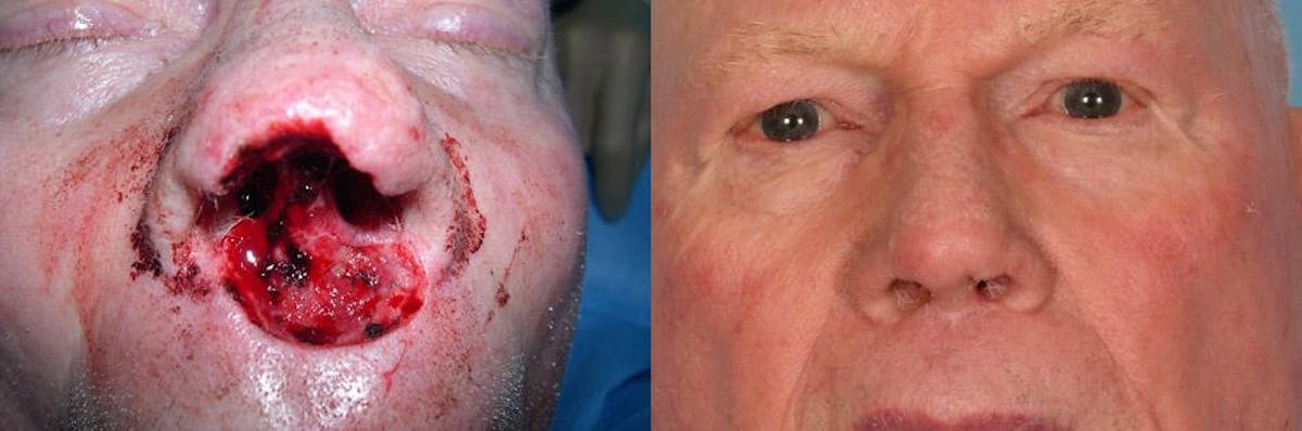Skin Cancer Before & After Gallery - Patient 198091 - Image 2
