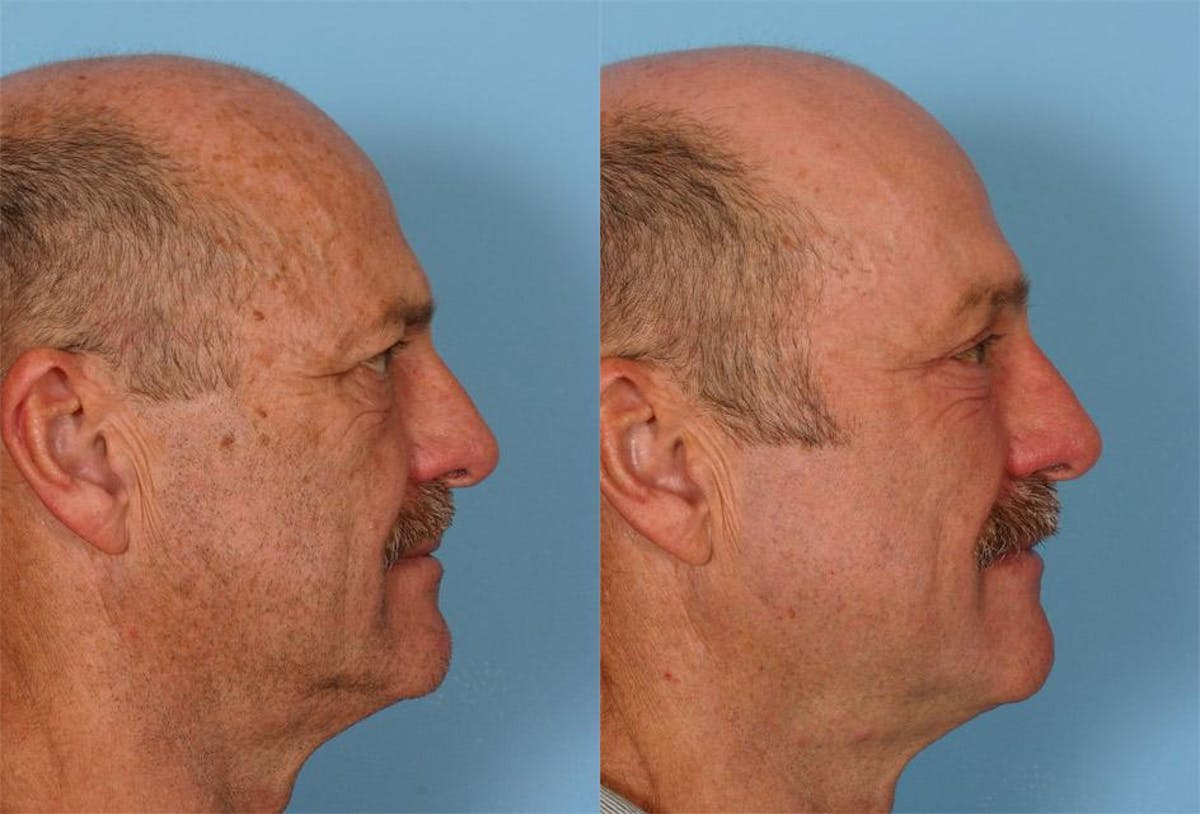 Endoscoplic Browlift Before & After Gallery - Patient 823519 - Image 3