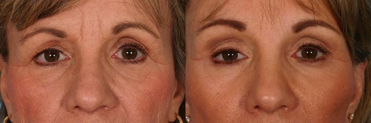 Facelift Before & After Gallery - Patient 301695 - Image 4